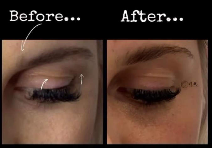 Dermal Filler Consultation