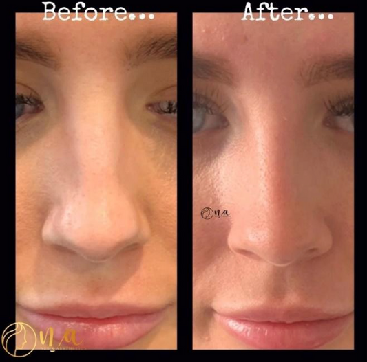 Non-Surgical Rhinoplasty