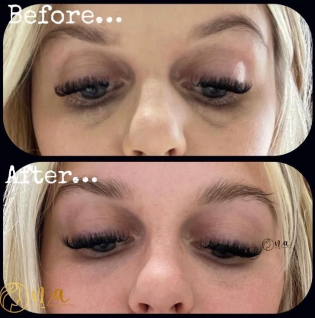 Under Eye Consultation (Polynucleotide/ TT filler/ Light Eyes)
