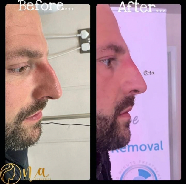 Non-Surgical Rhinoplasty