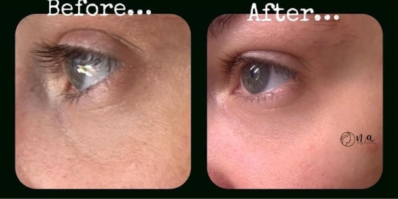 Under Eye Consultation (Polynucleotide/ TT filler/ Light Eyes)