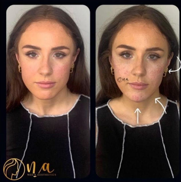 Dermal Filler Package