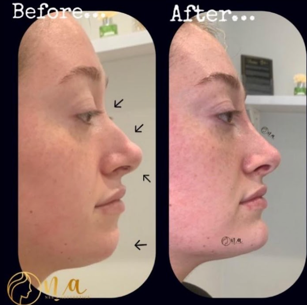 Dermal Filler Packages (2ml + Non-surgical Rhinoplasty)
