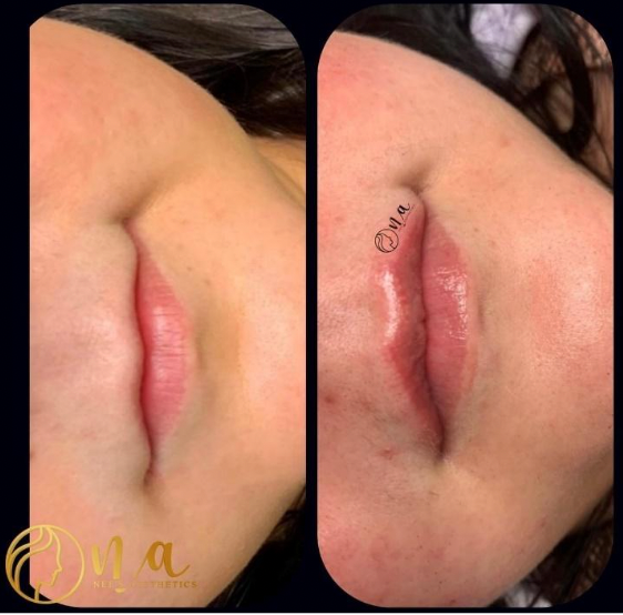 Lip Enhancement