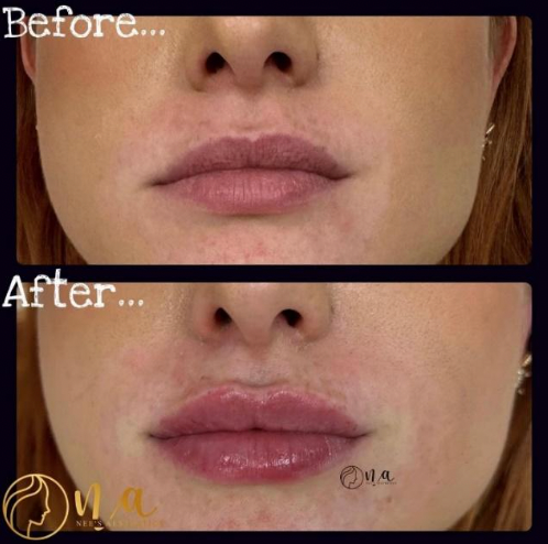 Lip Enhancement