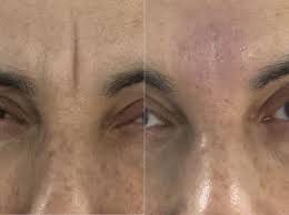 Deep set frown lines