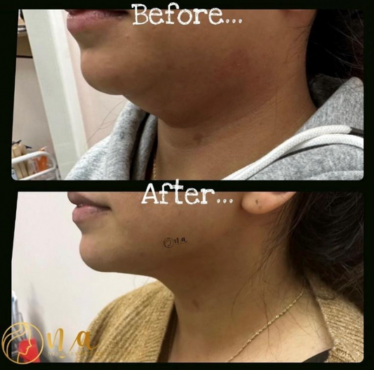 Fat Dissolving Consultation