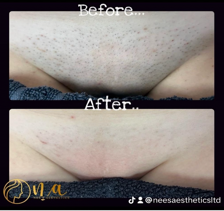 Large Area of Laser Hair Removal