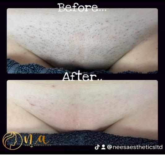 Large Area of Laser Hair Removal