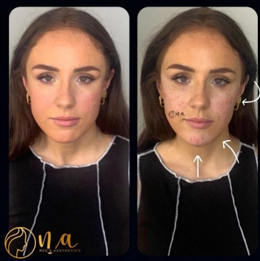 Dermal Filler Package