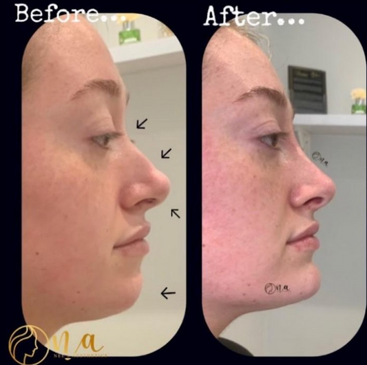 Dermal Filler Packages (2ml + Non-surgical Rhinoplasty)