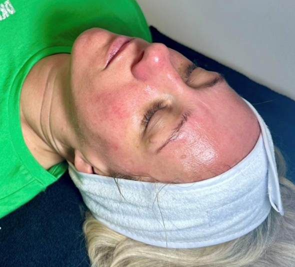 Carboxtherapy C02 facial