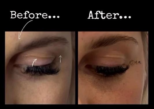 Brow Lift