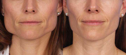 Masseter Reduction (Jawline Slimming)