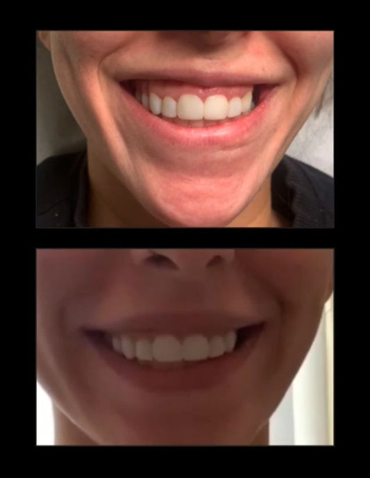 Gummy Smile correction