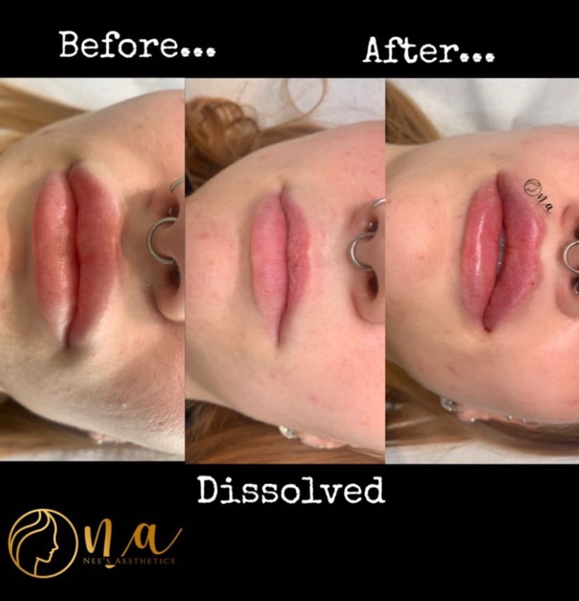 Dissolving Of Dermal Filler